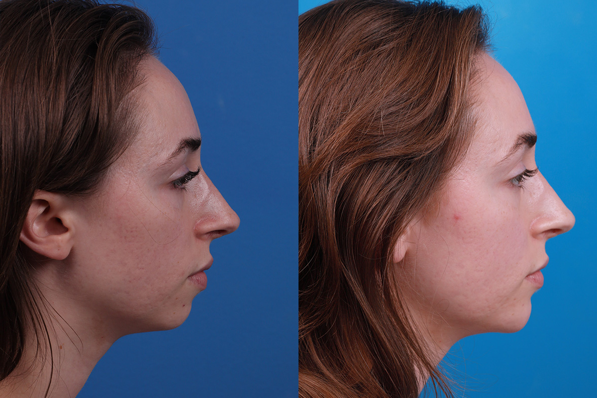 Dermal Fillers Before & After Gallery - Patient 388098 - Image 3