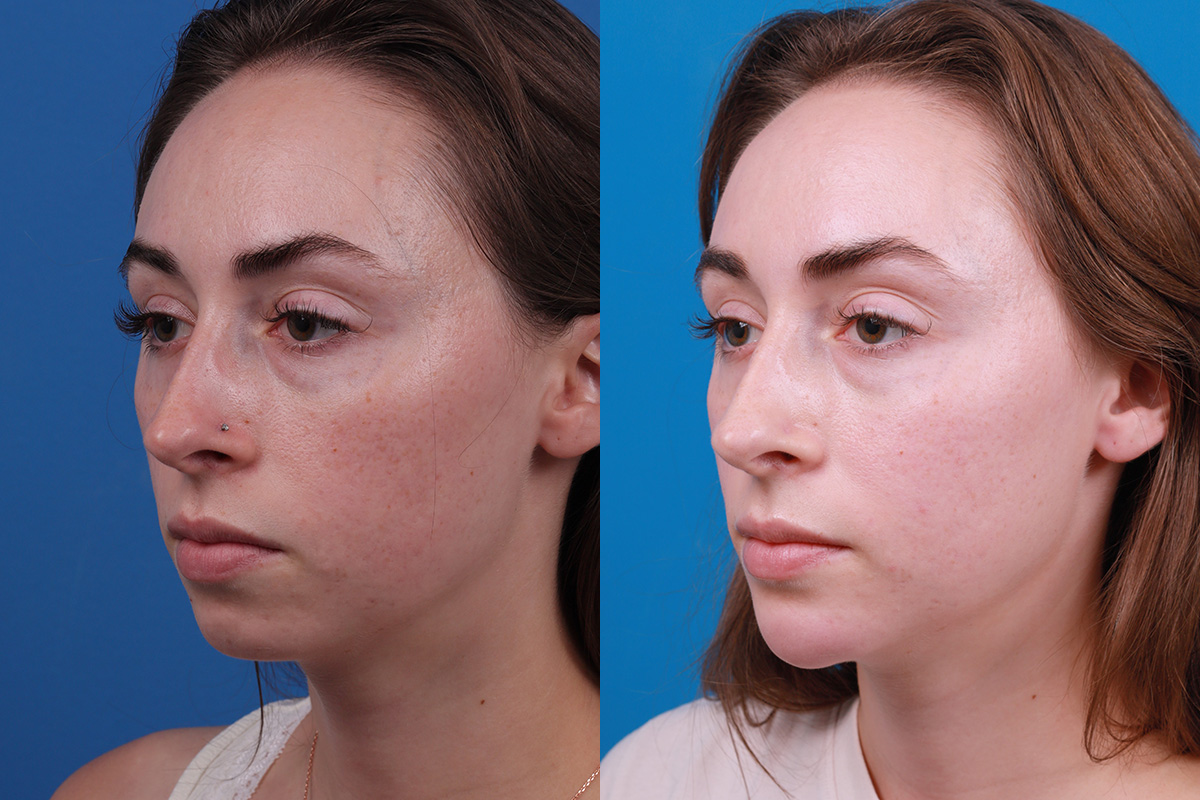Dermal Fillers Before & After Gallery - Patient 388098 - Image 4