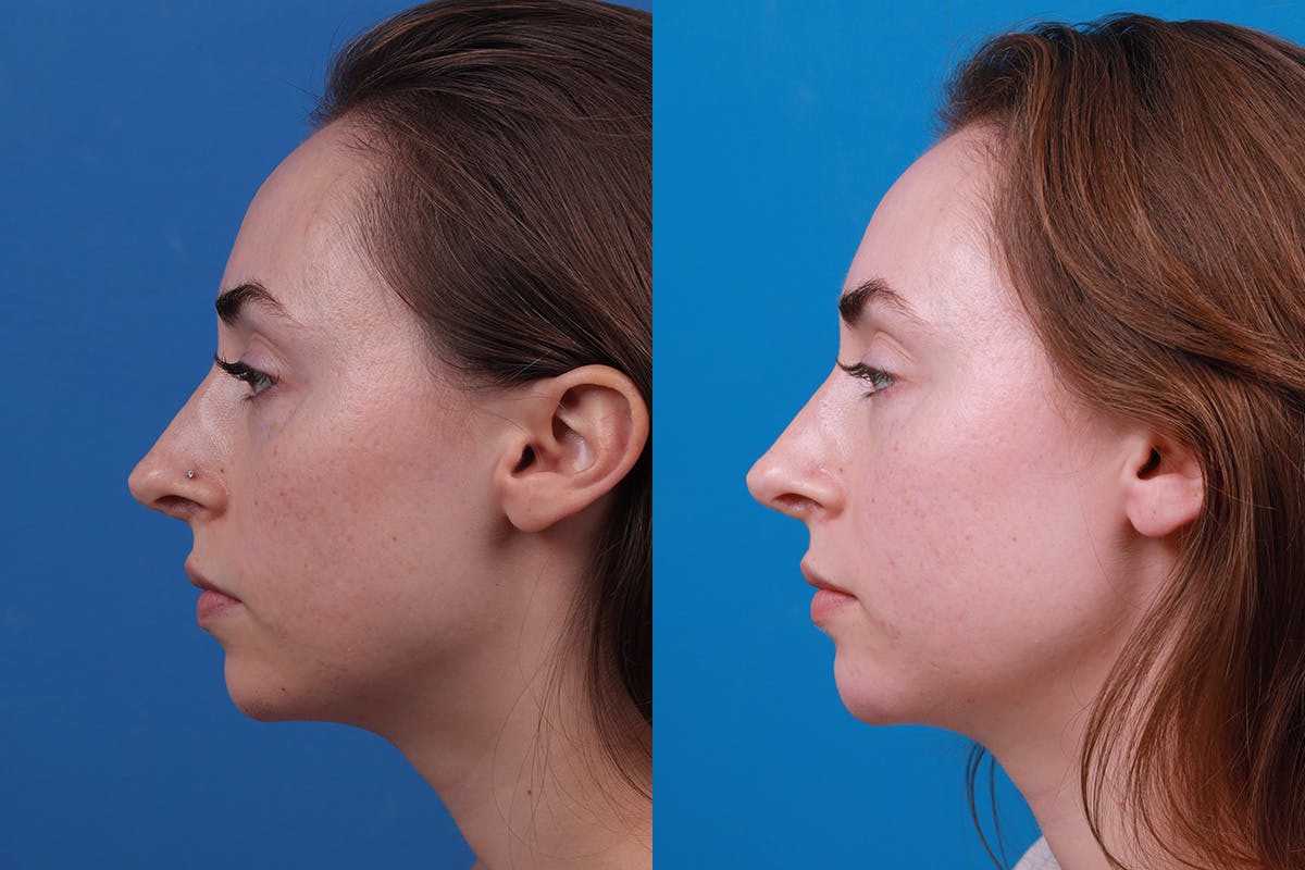 Dermal Fillers Before & After Gallery - Patient 388098 - Image 5