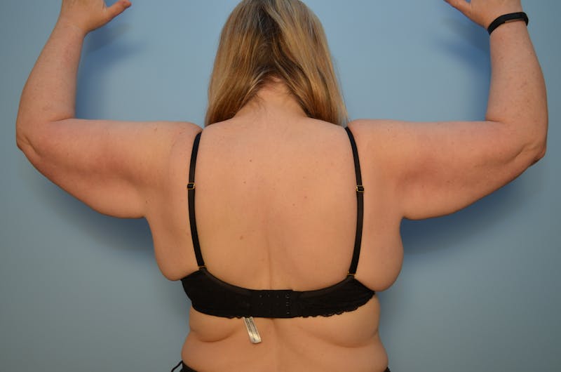 Arm Lift Before & After Gallery - Patient 884137 - Image 1