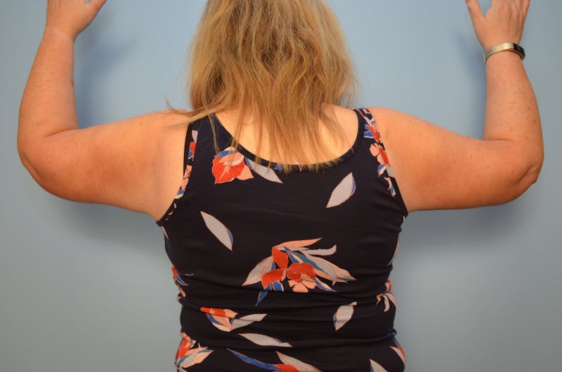 Arm Lift Before & After Gallery - Patient 884137 - Image 2
