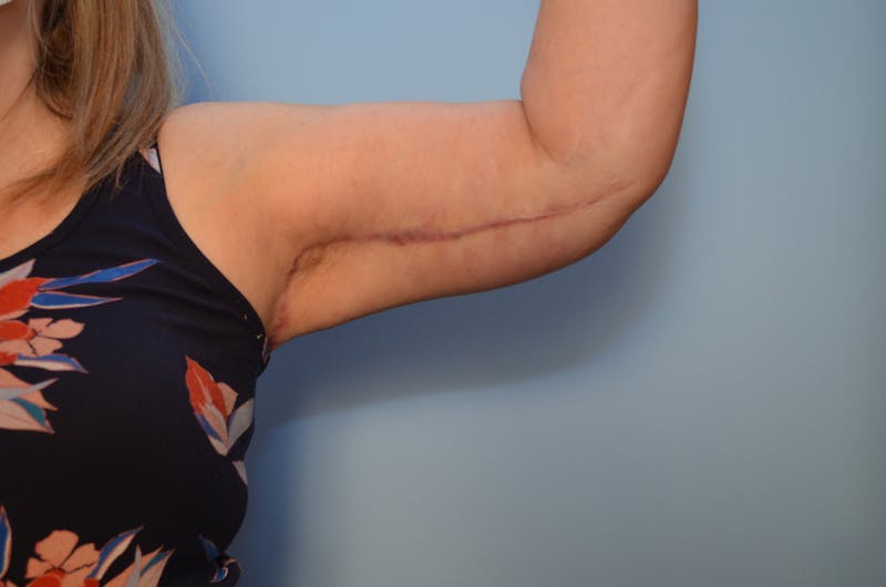Arm Lift Before & After Gallery - Patient 884137 - Image 3