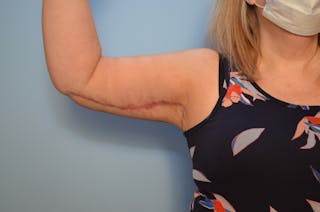 Arm Lift Before & After Gallery - Patient 884137 - Image 4