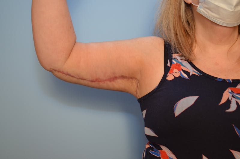Arm Lift Before & After Gallery - Patient 884137 - Image 4