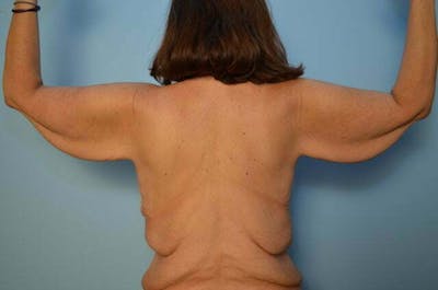Arm Lift Before & After Gallery - Patient 377351 - Image 1