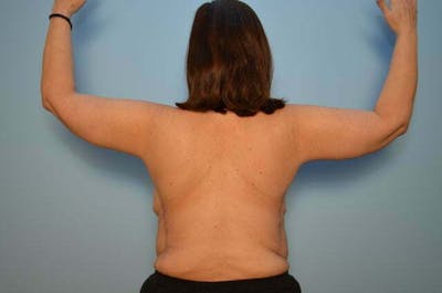 Arm Lift Before & After Gallery - Patient 377351 - Image 2