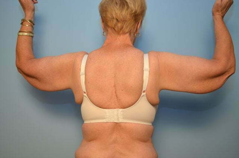 Arm Lift Before & After Gallery - Patient 408161 - Image 1