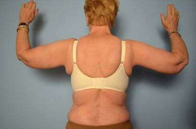 Arm Lift Before & After Gallery - Patient 117867 - Image 2