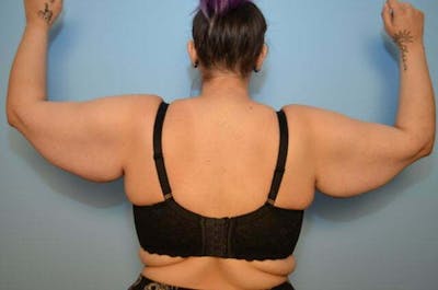 Arm Lift Before & After Gallery - Patient 162216 - Image 1