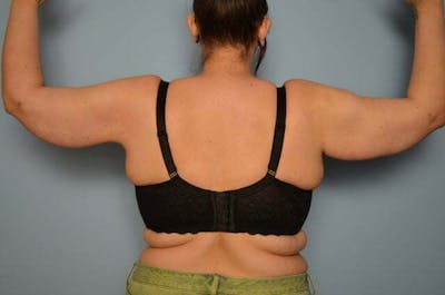 Arm Lift Before & After Gallery - Patient 162216 - Image 2