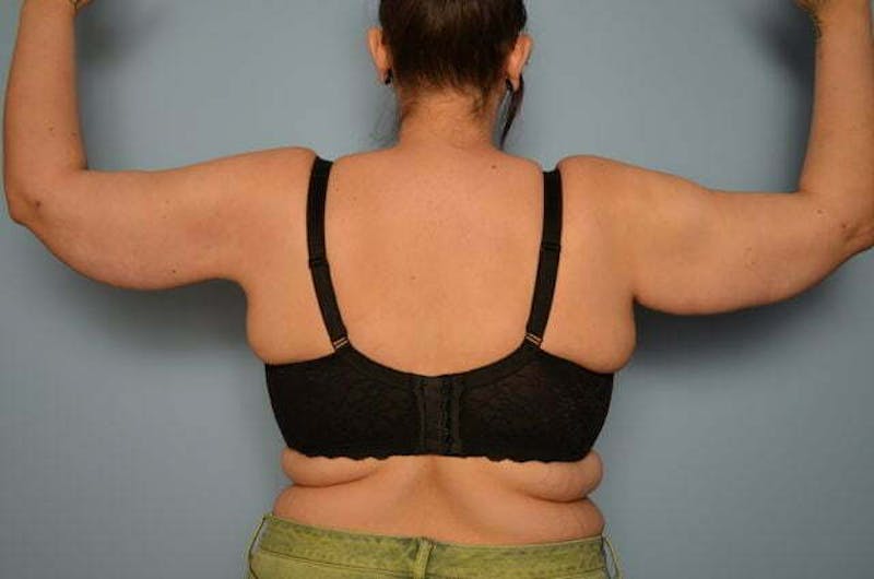 Arm Lift Before & After Gallery - Patient 302017 - Image 2