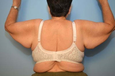 Arm Lift Before & After Gallery - Patient 325281 - Image 1