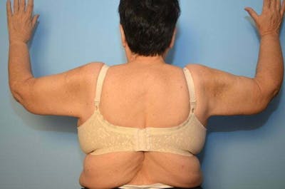 Arm Lift Before & After Gallery - Patient 325281 - Image 2