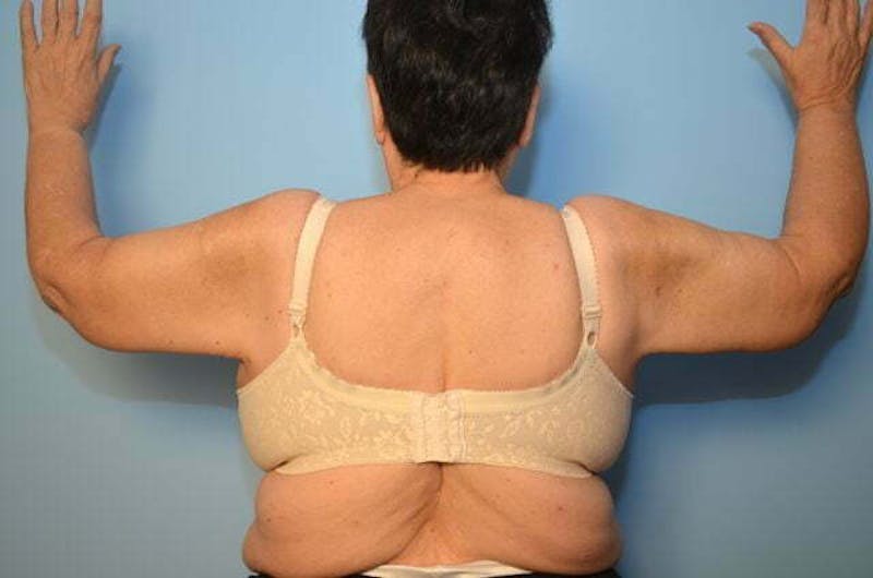 Arm Lift Before & After Gallery - Patient 577023 - Image 2