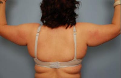 Arm Lift Before & After Gallery - Patient 163350 - Image 1