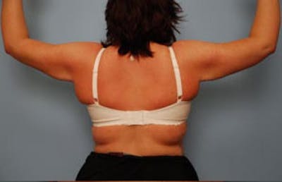 Arm Lift Before & After Gallery - Patient 163350 - Image 2