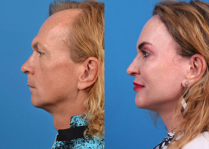 Facial Feminization Before & After Gallery - Patient 274243 - Image 1