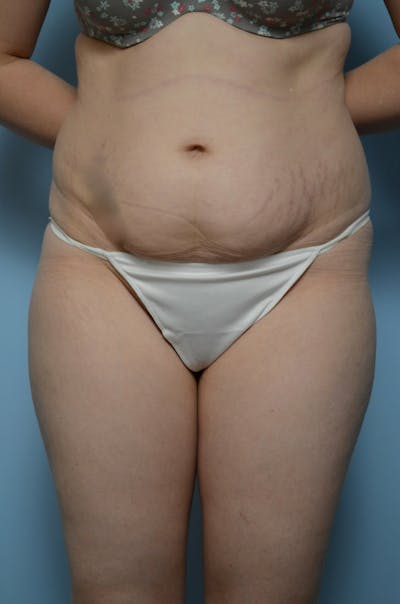 Body Contouring Before & After Gallery - Patient 243102 - Image 1