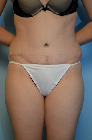 Tummy Tuck Before & After Gallery - Patient 518727 - Image 2