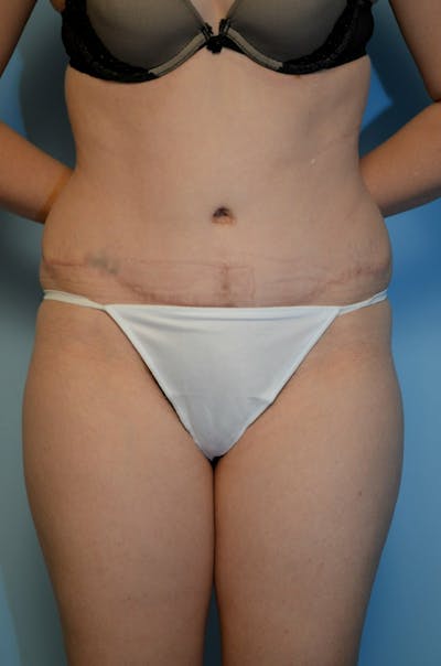 Body Contouring Before & After Gallery - Patient 243102 - Image 2