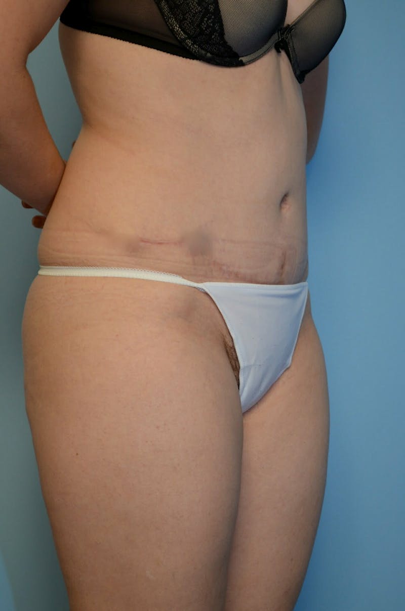 Tummy Tuck Before & After Gallery - Patient 518727 - Image 4