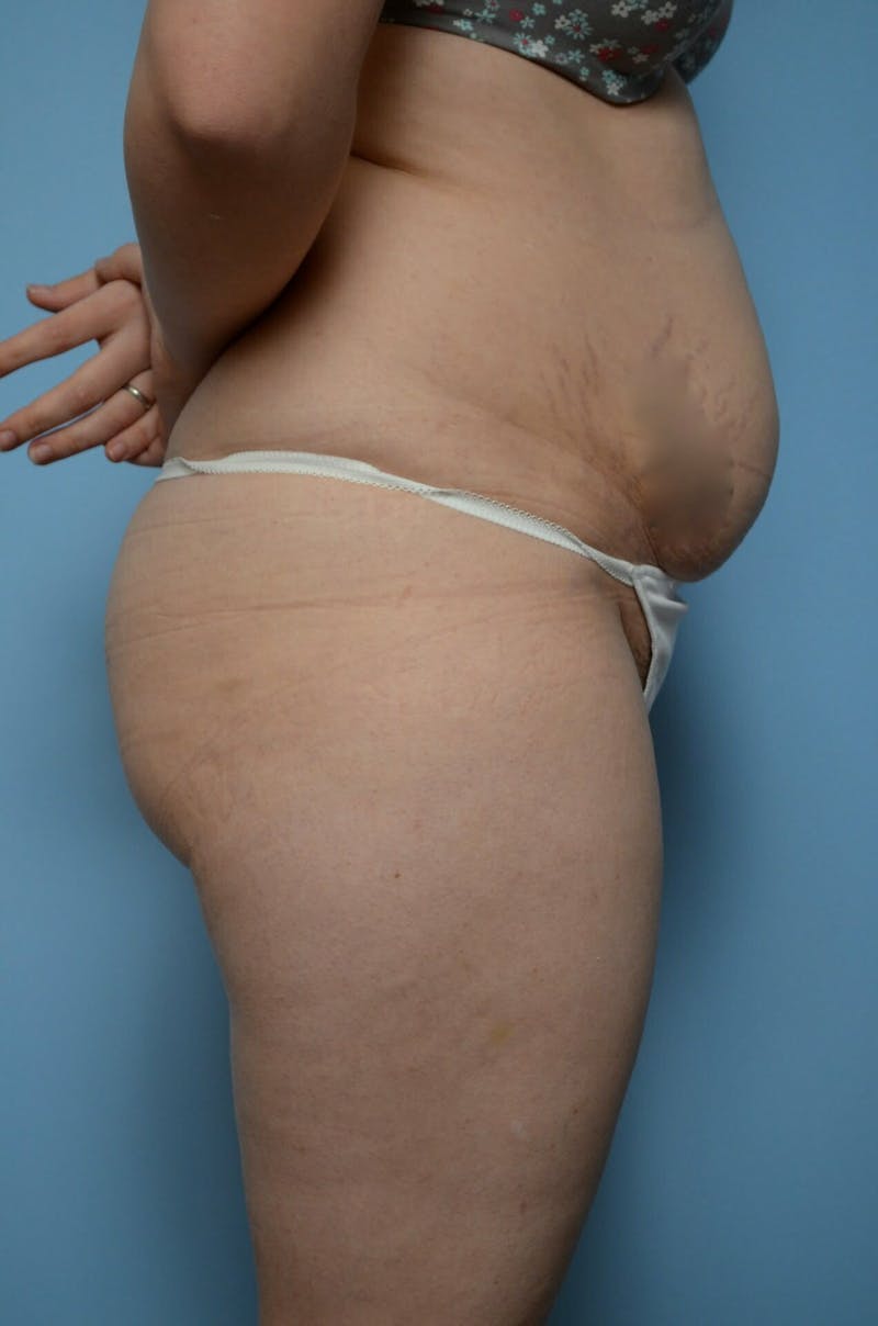 Tummy Tuck Before & After Gallery - Patient 518727 - Image 5
