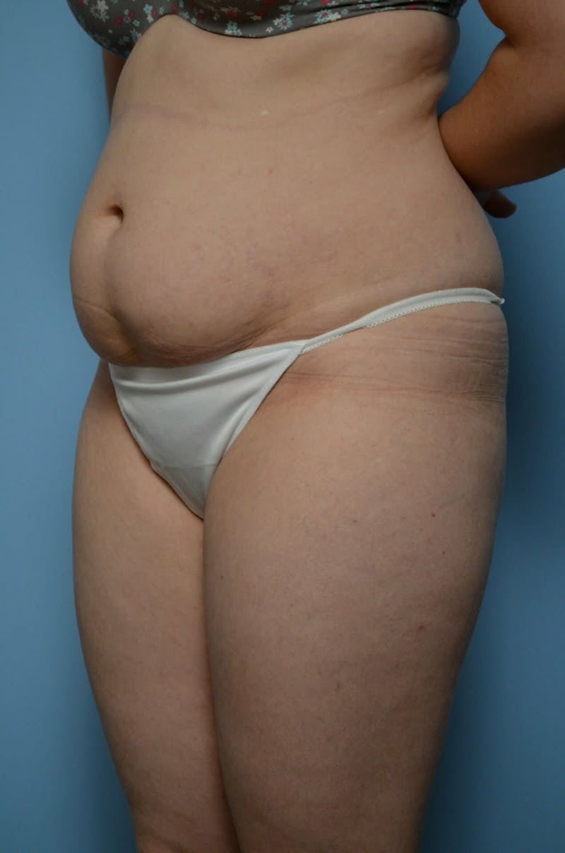 Tummy Tuck Before & After Gallery - Patient 518727 - Image 7