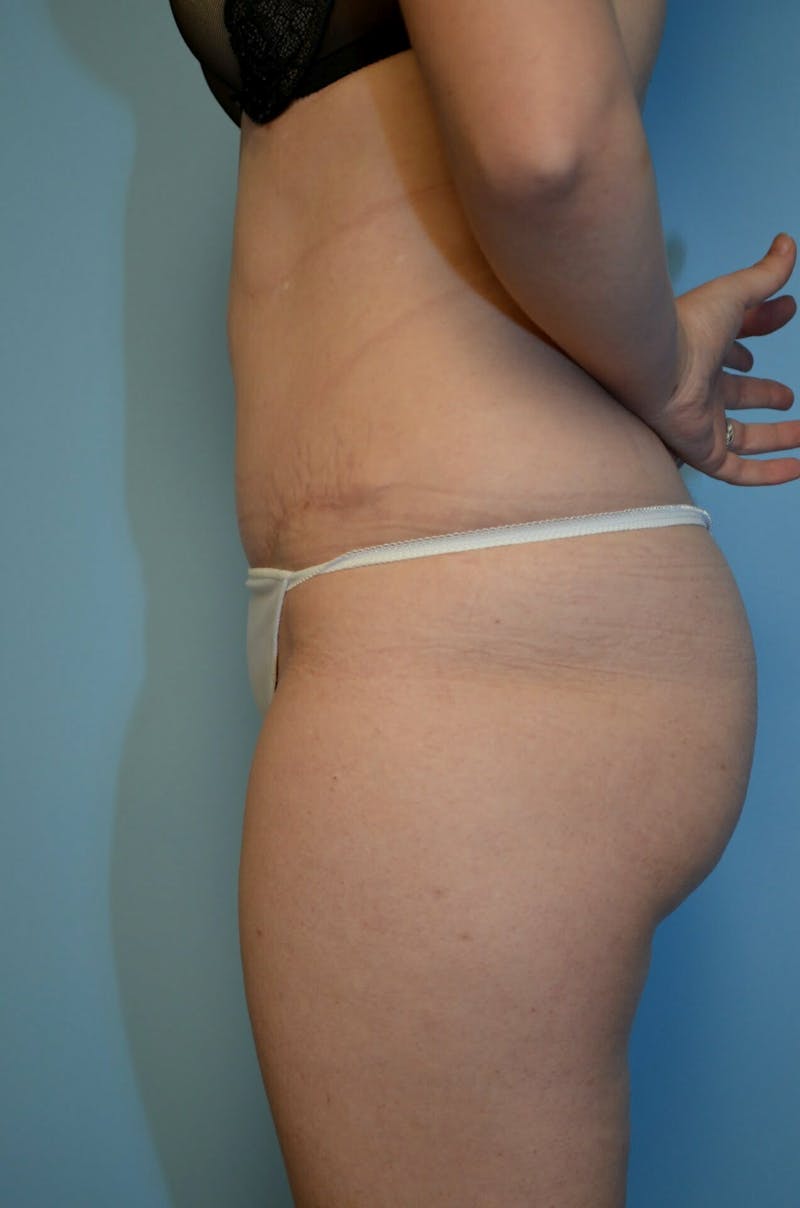 Tummy Tuck Before & After Gallery - Patient 518727 - Image 10