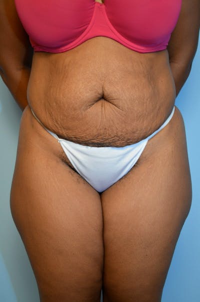 Body Contouring Before & After Gallery - Patient 121629 - Image 1