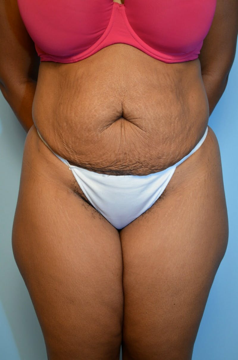 Tummy Tuck Before & After Gallery - Patient 245402 - Image 1