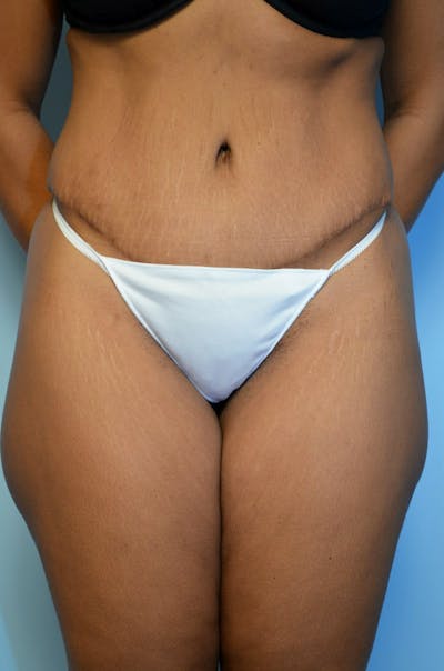 Body Contouring Before & After Gallery - Patient 121629 - Image 2
