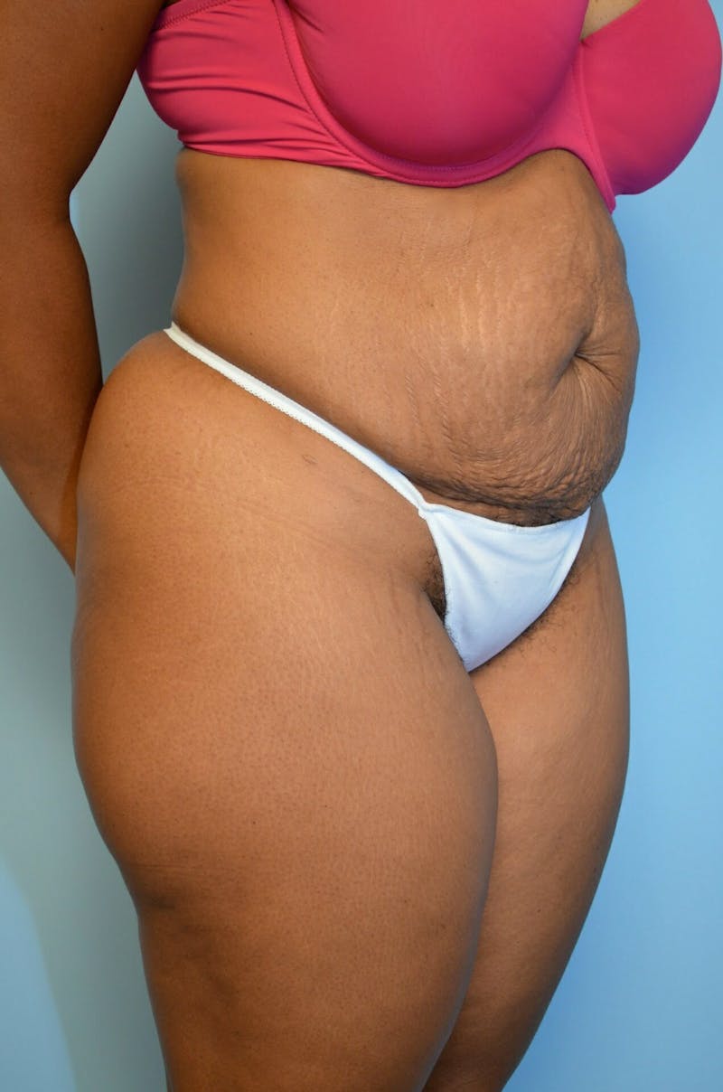 Tummy Tuck Before & After Gallery - Patient 245402 - Image 3