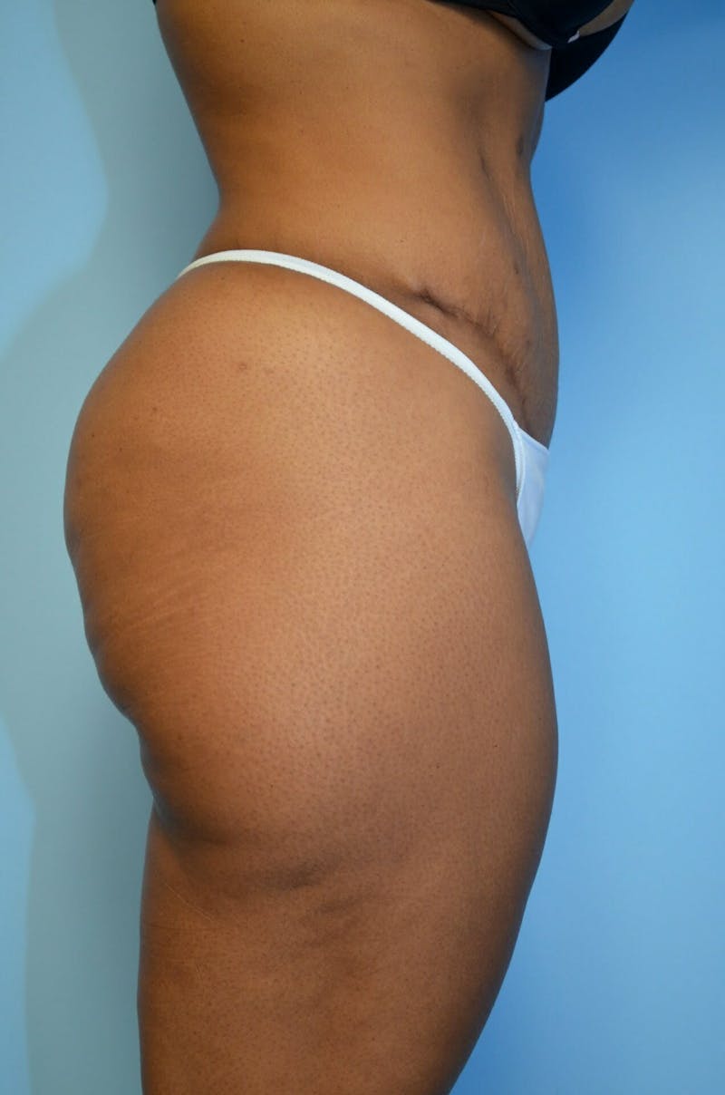 Tummy Tuck Before & After Gallery - Patient 245402 - Image 6
