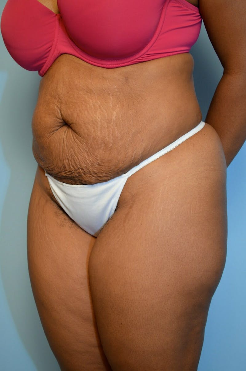 Tummy Tuck Before & After Gallery - Patient 245402 - Image 7
