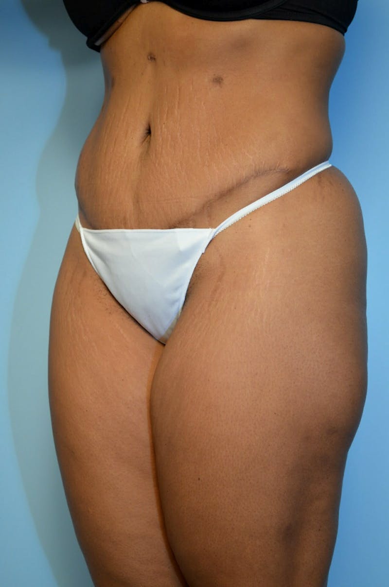 Tummy Tuck Before & After Gallery - Patient 245402 - Image 8