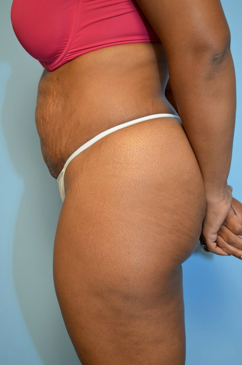 Tummy Tuck Before & After Gallery - Patient 245402 - Image 9