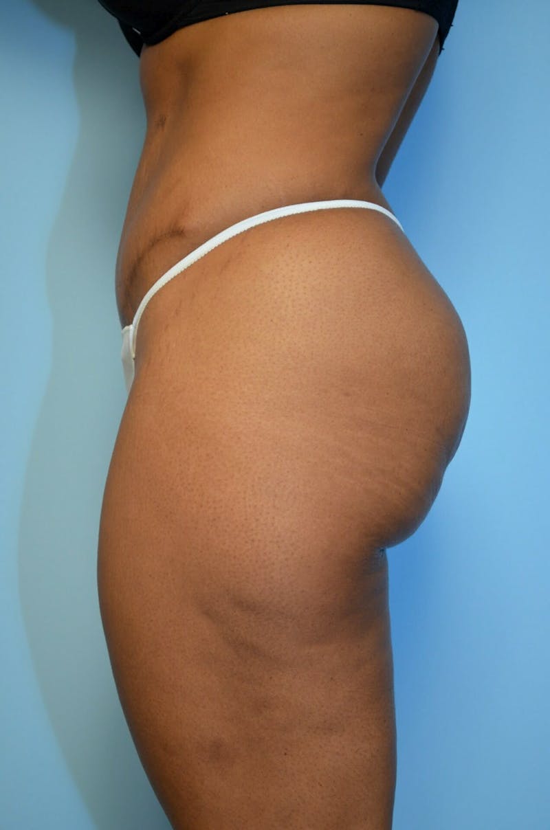 Tummy Tuck Before & After Gallery - Patient 245402 - Image 10