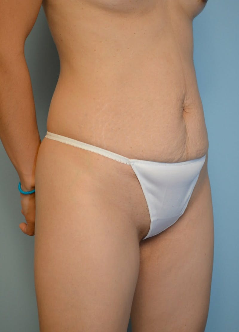 Umbilical Float Tummy Tuck Before & After Gallery - Patient 428754 - Image 3