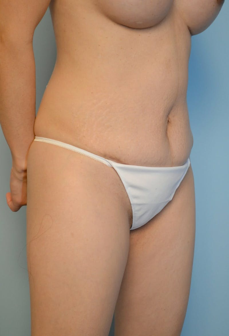 Umbilical Float Tummy Tuck Before & After Gallery - Patient 428754 - Image 4