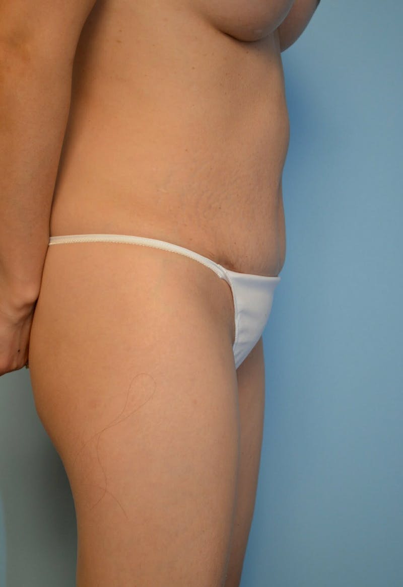 Umbilical Float Tummy Tuck Before & After Gallery - Patient 428754 - Image 6