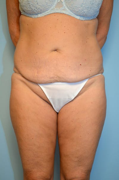 Body Contouring Before & After Gallery - Patient 370634 - Image 1