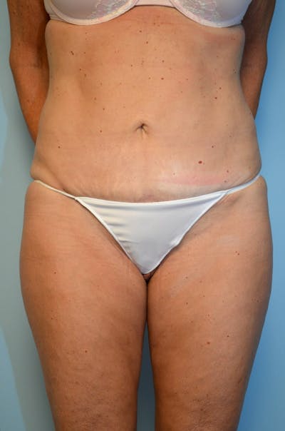 Body Contouring Before & After Gallery - Patient 370634 - Image 2