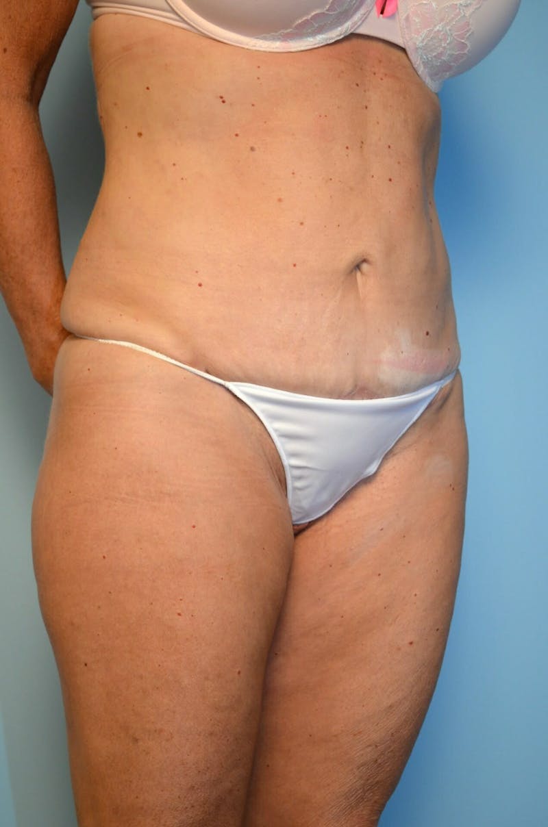 Liposuction Before & After Gallery - Patient 268952 - Image 4