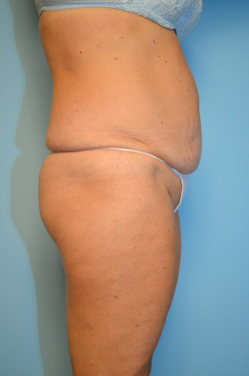 Liposuction Before & After Gallery - Patient 268952 - Image 5