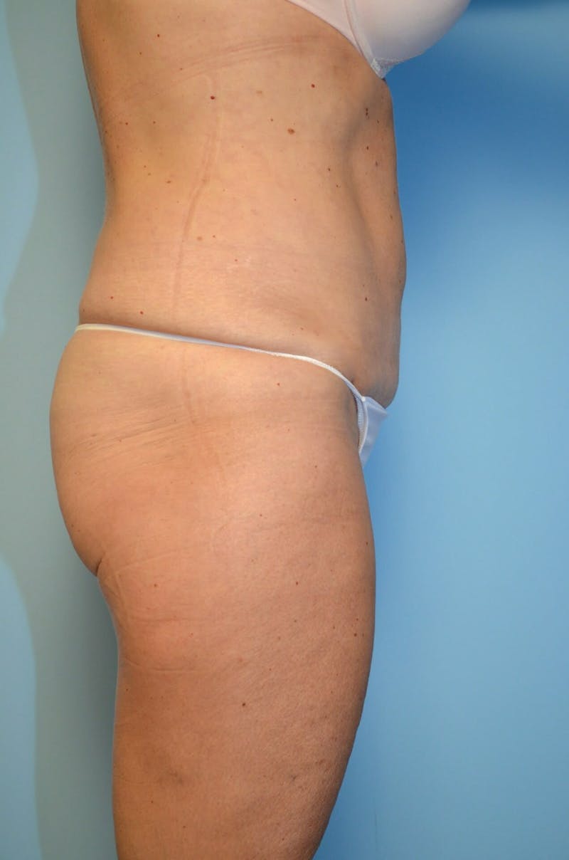 Liposuction Before & After Gallery - Patient 268952 - Image 6