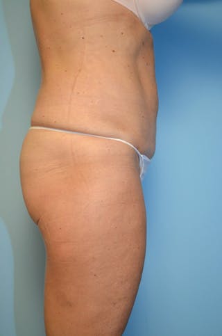 Mini Tummy Tuck Before & After Gallery - Patient 367248 - Image 6