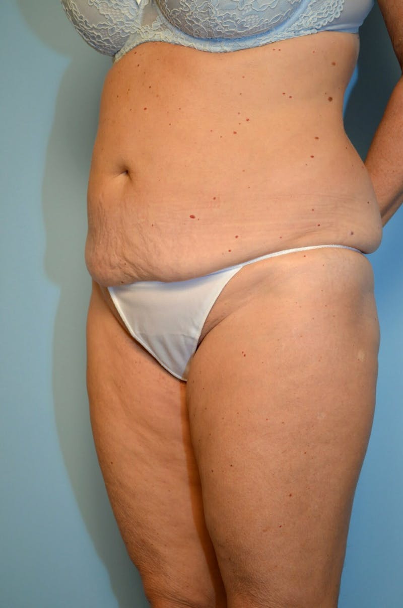 Liposuction Before & After Gallery - Patient 268952 - Image 7