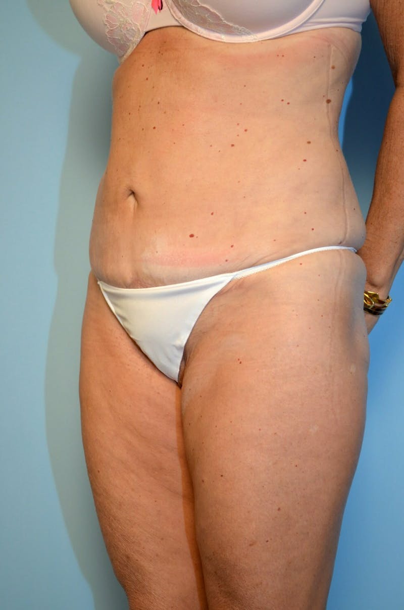 Liposuction Before & After Gallery - Patient 268952 - Image 8