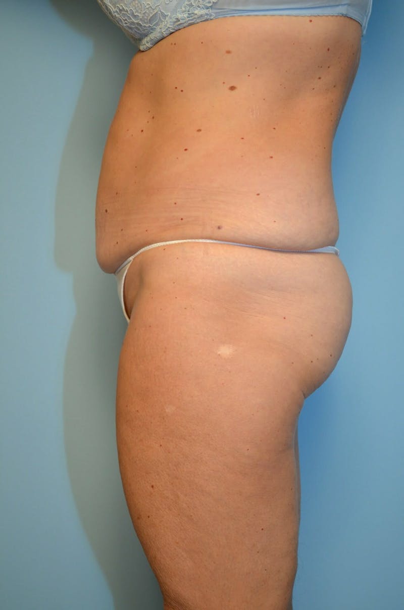Liposuction Before & After Gallery - Patient 268952 - Image 9