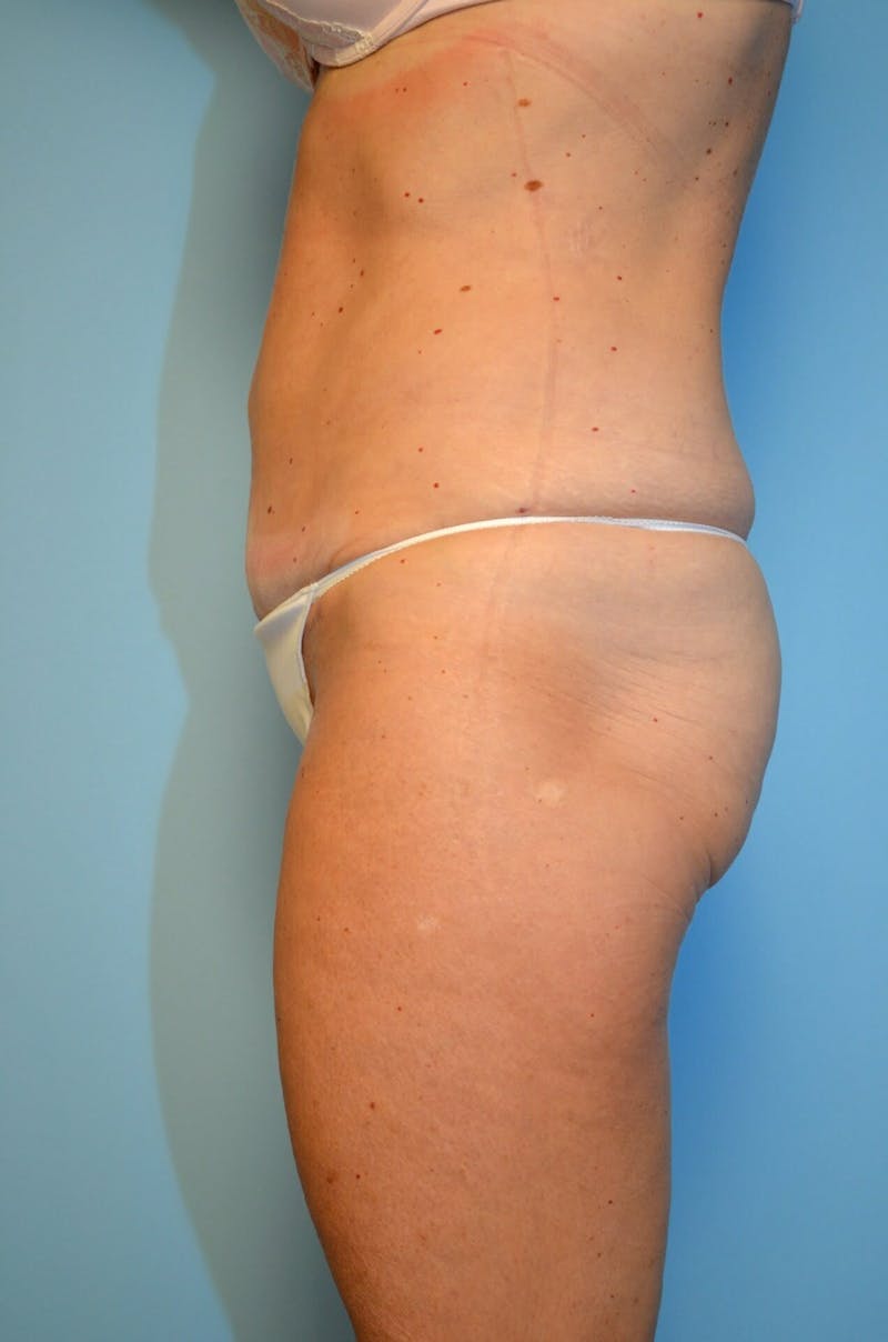 Liposuction Before & After Gallery - Patient 268952 - Image 10